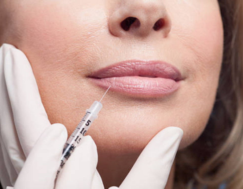 Female lips at injection filler treatment