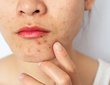 The Medspa at Connecticut Facial Plastic: Acne & Acne Scar Treatment in CT