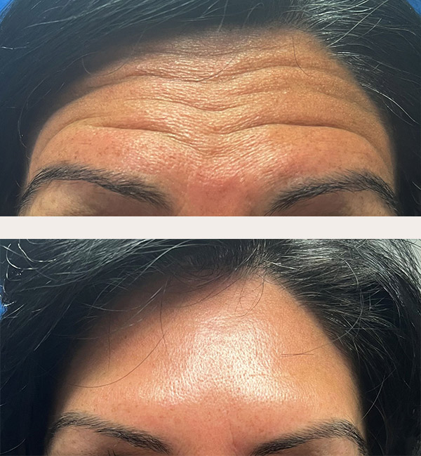 Woman’s forehead, before and after Botox treatment, front view, patient 2