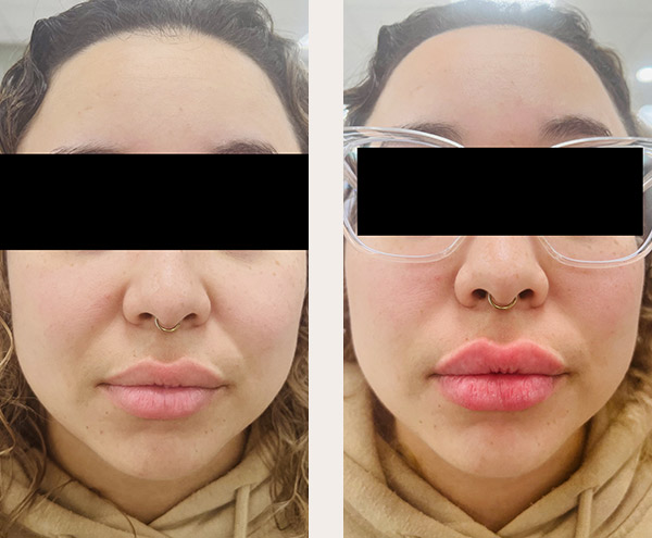 Woman’s face, before and after Juvederm treatment, front view, patient 3