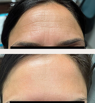 Female forehead, before and after Botox treatment, front view, patient 1