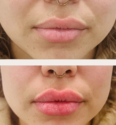 Female lips, before and after Juvéderm treatment, front view, patient 3